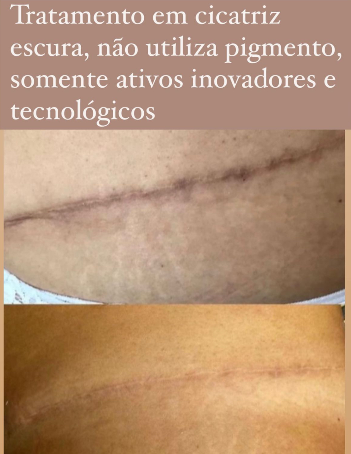 Não é nudez, é camuflagem estética